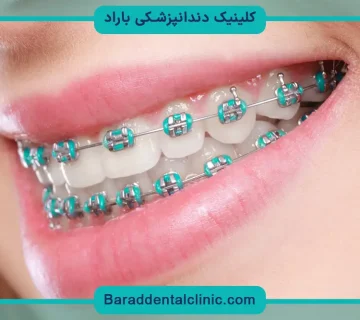 زمان رگلاژ دندان