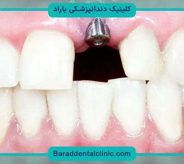 چند نوع کاشت دندان داریم