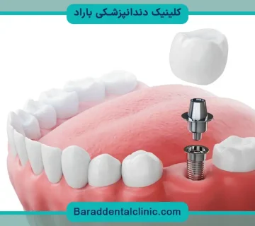کاشت دندان چقدر طول میکشد