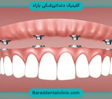 جدیدترین مدل کاشت دندان
