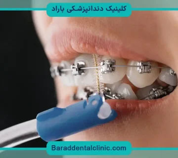مرتب سازی دندان در خانه