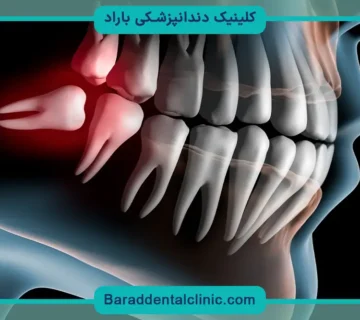 مقایسه هزینه ایمپلنت با دندان مصنوعی