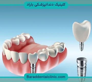 کاشت دندان ایمپلنت