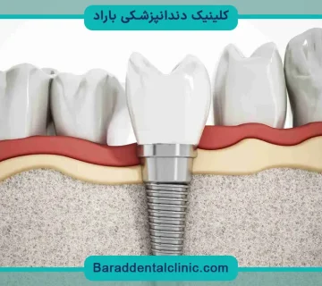 فیلم کاشت دندان ثابت
