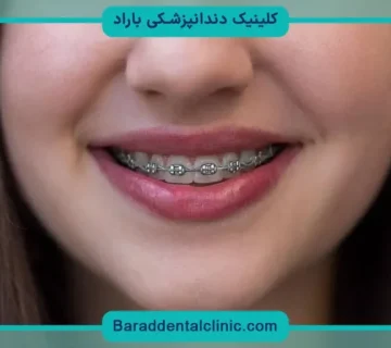 هزینه رگلاژ دندان