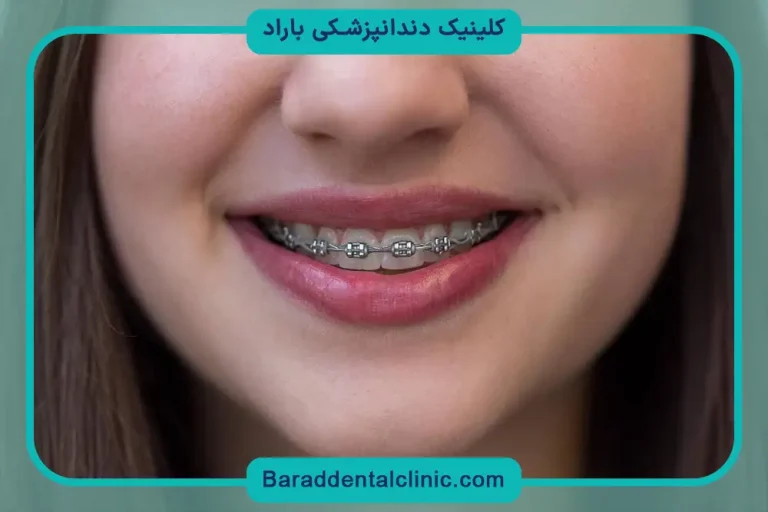 هزینه رگلاژ دندان