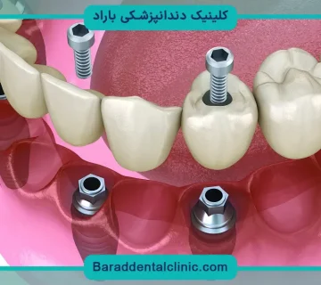 کاشت دندان چه نام دارد