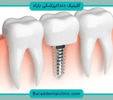 چند روش کاشت دندان داریم