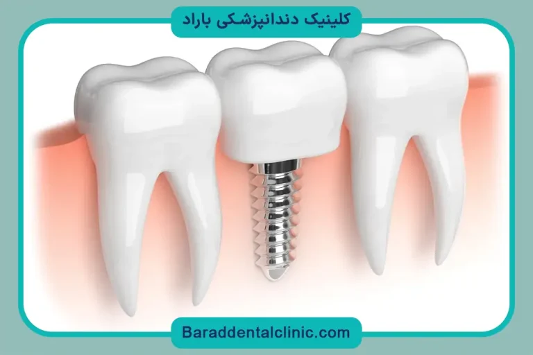 چند روش کاشت دندان داریم