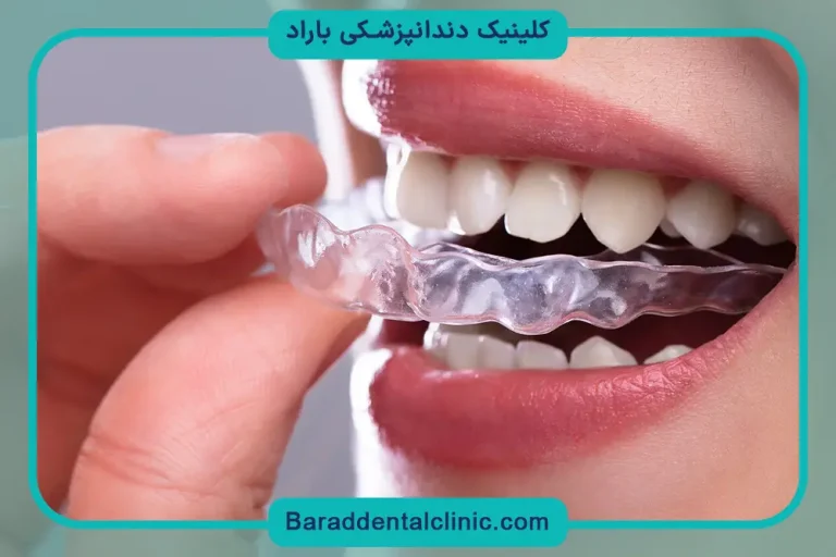 رگلاژ دندان تهران
