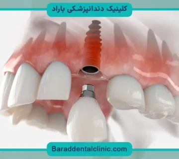هزینه ایمپلنت با بیمه تکمیلی