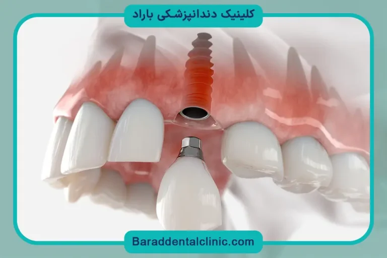 هزینه ایمپلنت با بیمه تکمیلی