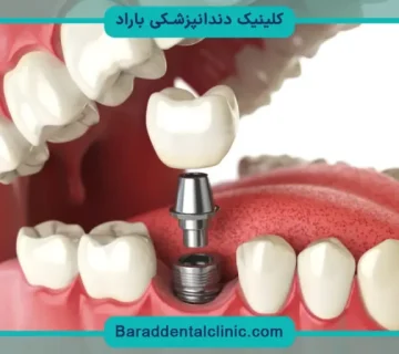 قیمت ایمپلنت کره ای
