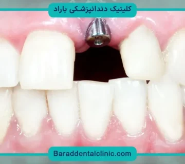 کاشت دندان چند سال دوام دارد