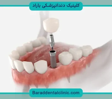 قیمت ایمپلنت ثابت دندان