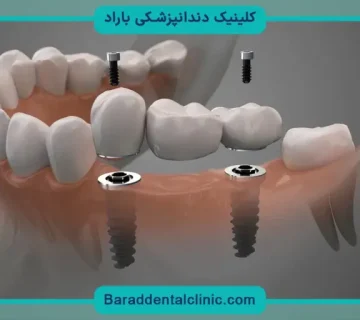 هزینه ایمپلنت ثابت