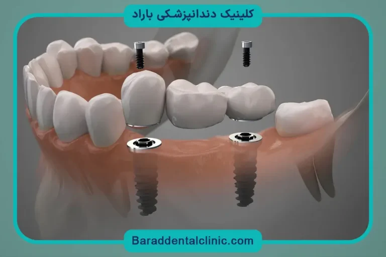 نحوه کاشت دندان ثابت