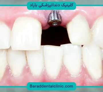 هزینه کاشت دندان جلو