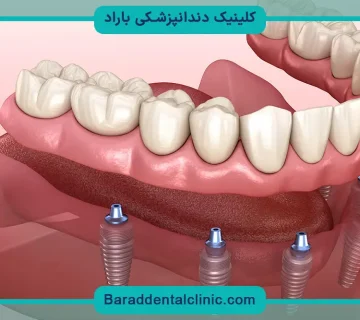 جراحی ایمپلنت فک پایین