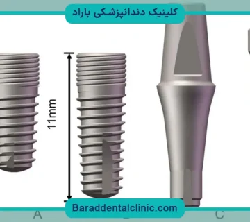 فیکسچر ایمپلنت