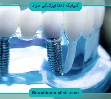 فیکسچر دندان چیست