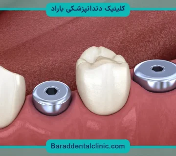 فیکسچر ایمپلنت چیست