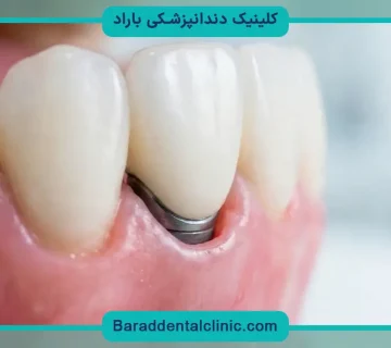 کاشت دندان جلو قیمت