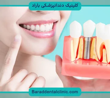 کاشت دندان چقدر هزینه دارد