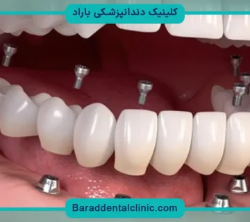 قیمت کاشت دندان