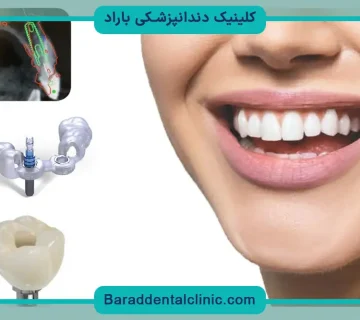 هزینه ایمپلنت دندان