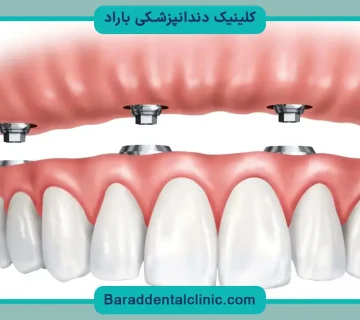 قیمت کاشت دندان با چسب