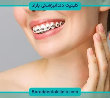 قیمت براکت دندان ارتودنسی