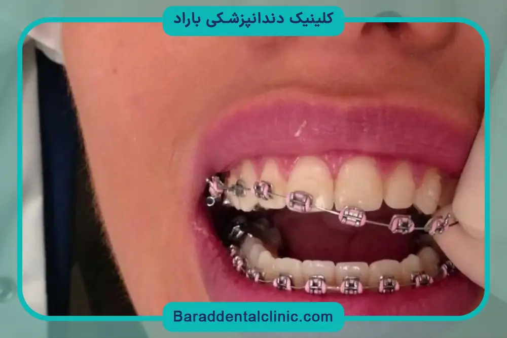 جدا شدن براکت دندان