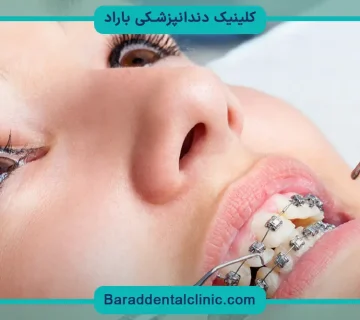 چگونه براکت دندان را نصب کنیم