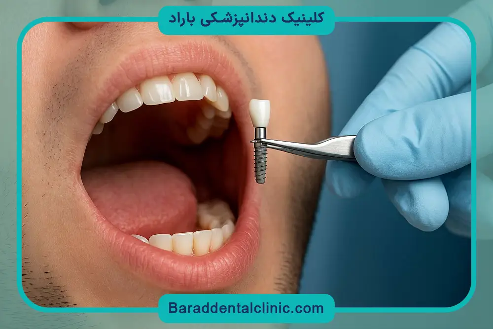 ایمپلنت دندان درد دارد؟