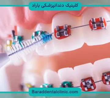 براکت رنگی دندان