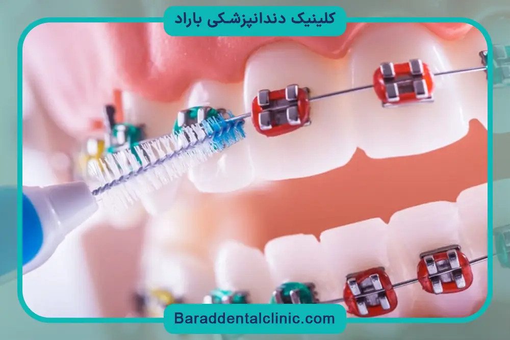 براکت رنگی دندان