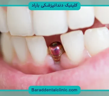 ایمپلنت دندان جلو