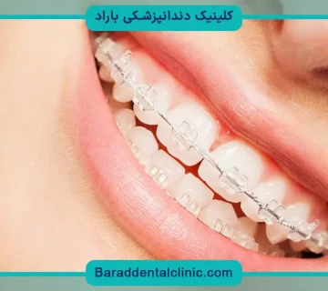 براکت شفاف دندان