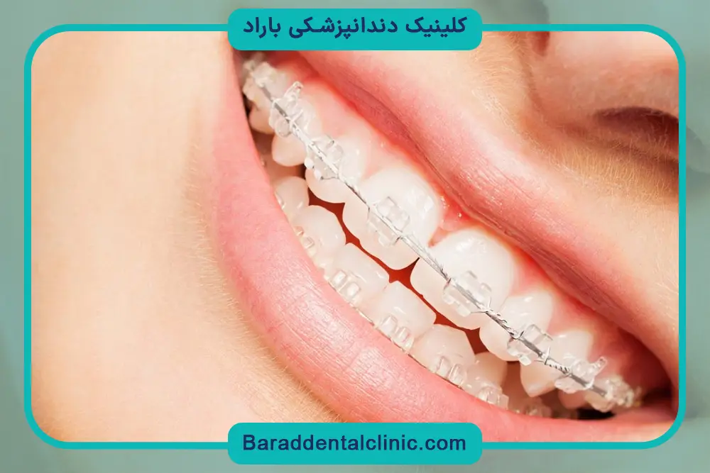 براکت شفاف دندان