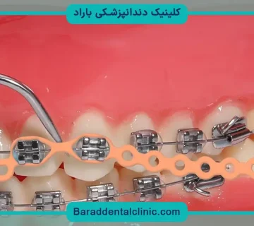 براکت دندان نواری