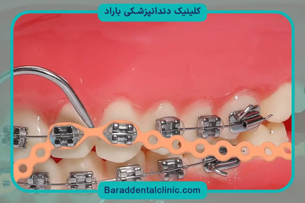 براکت دندان نواری