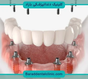 پایه دندان مصنوعی