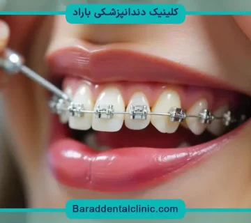 براکت دندانپزشکی