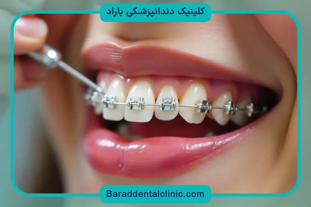 براکت دندانپزشکی