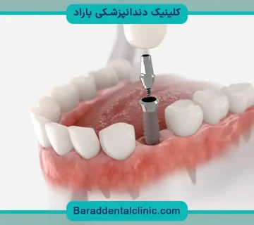 مراحل ایمپلنت دندان