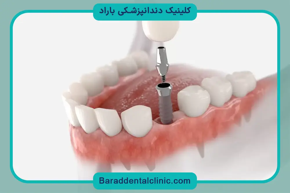 مراحل ایمپلنت دندان