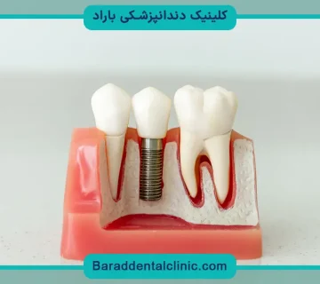 قیمت ایمپلنت دیجیتال چقدر است