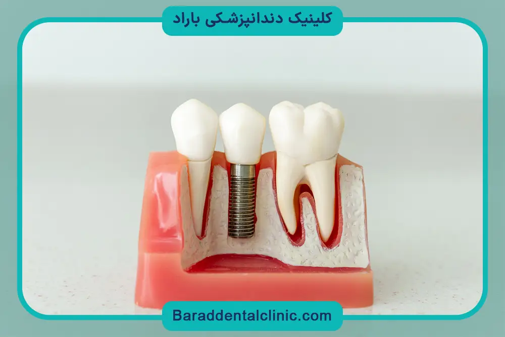 قیمت ایمپلنت دیجیتال چقدر است