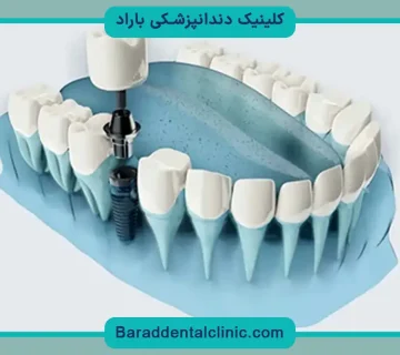 ایمپلنت دیجیتال اقساطی